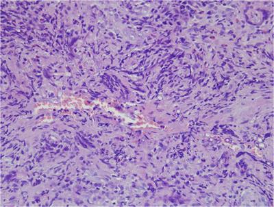 Rhino-Orbital-Cerebral Mycosis and Extranodal Natural Killer or/and T-Cell Lymphoma, Nasal Type